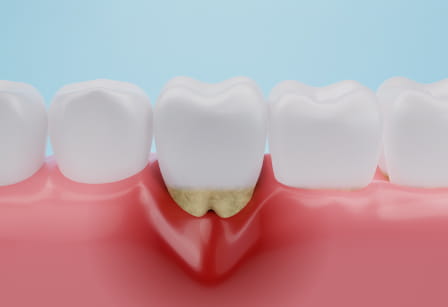 「歯周病」とその原因